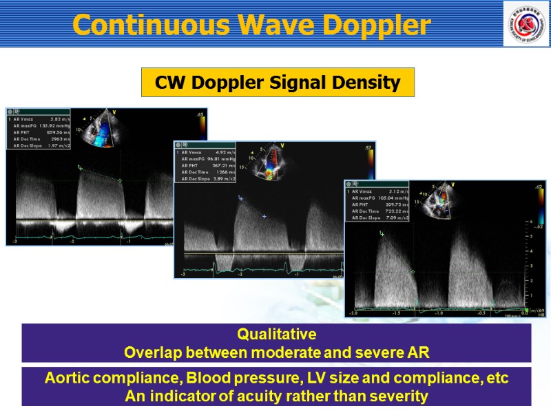 Continuous Wave Doppler CW Doppler Signal Density Qualitative Overlap between moderate and severe AR